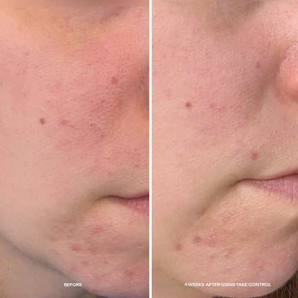 Take Control™ Salicylic + 10% Azelaic Acid Clarifying Serum
